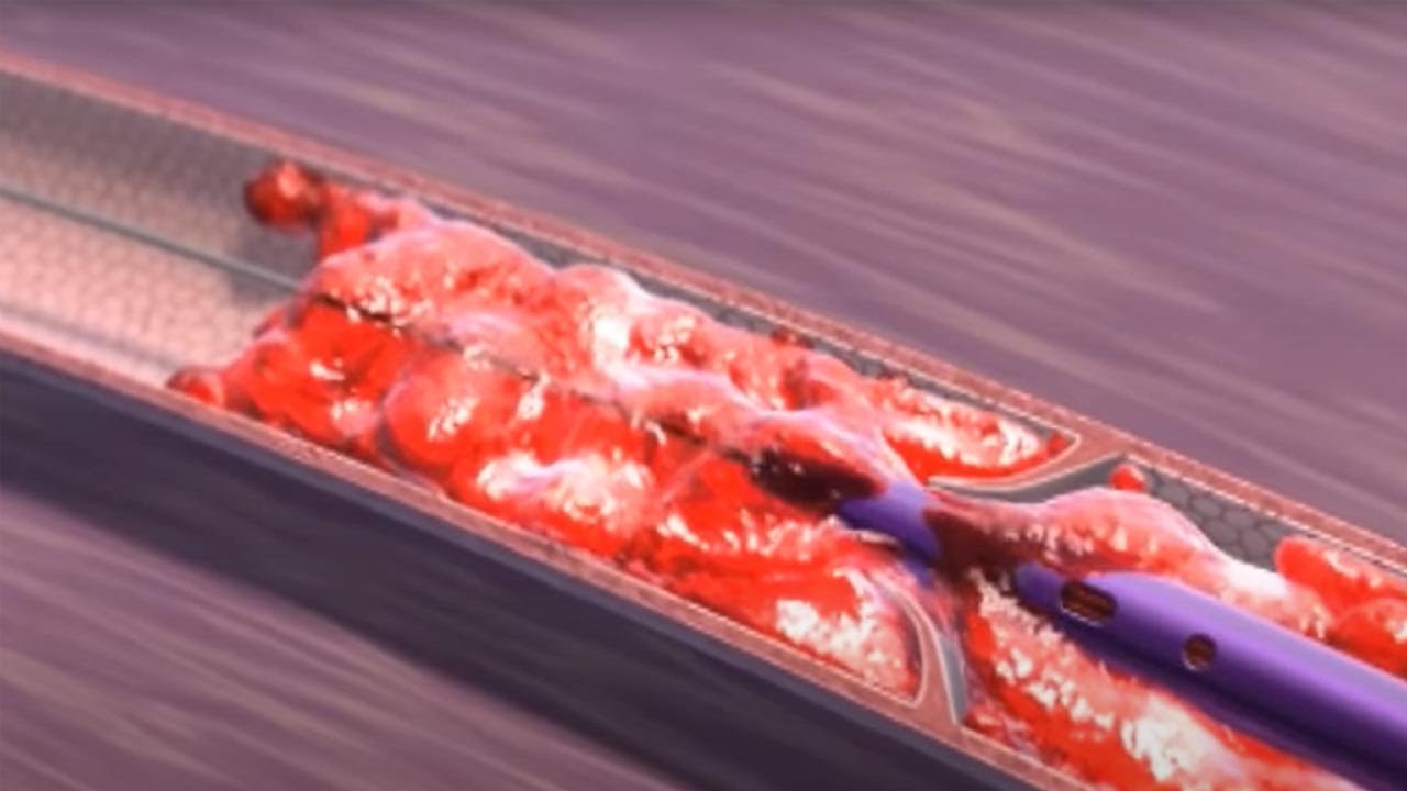 AngioJet Peripheral Thrombectomy Catheter Selaras Technology Indonesia